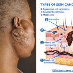 Different stages of cancer.