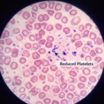 thrombocytopenia in pregnancy showing low platelet count symptoms and treatment in expecting mothers
