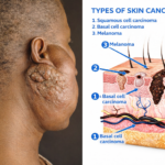 Different Stages of Cance