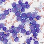 treatments and cures for leukemia