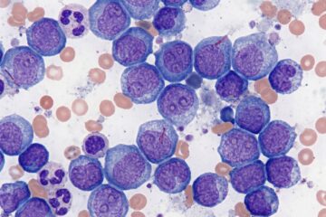 treatments and cures for leukemia