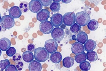 treatments and cures for leukemia