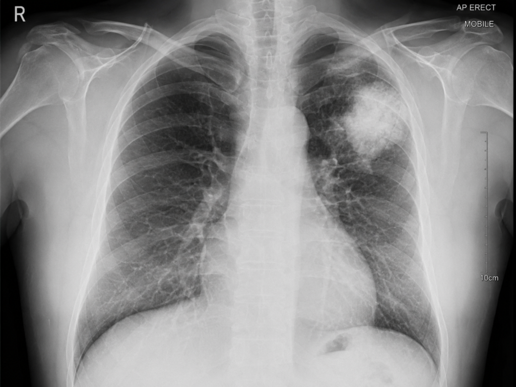 X Rays Cancer Meta Description: X rays cancer risk is a real concern many patients overlook. Discover 5 alarming truths about how x-rays affect cancer risk, who is most at risk, and how to stay safe during medical imaging.