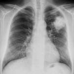 X Rays Cancer Meta Description: X rays cancer risk is a real concern many patients overlook. Discover 5 alarming truths about how x-rays affect cancer risk, who is most at risk, and how to stay safe during medical imaging.