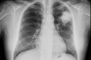 X Rays Cancer Meta Description: X rays cancer risk is a real concern many patients overlook. Discover 5 alarming truths about how x-rays affect cancer risk, who is most at risk, and how to stay safe during medical imaging.