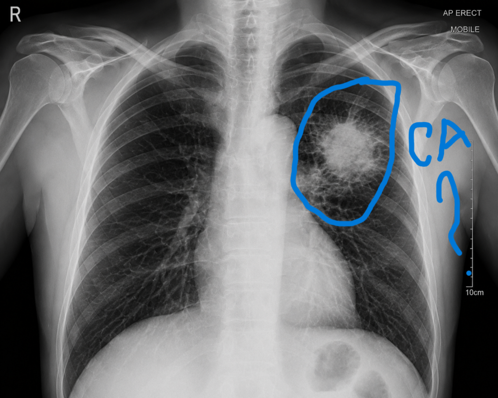 xrays cancer