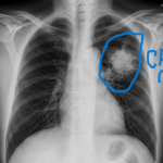 xrays cancer